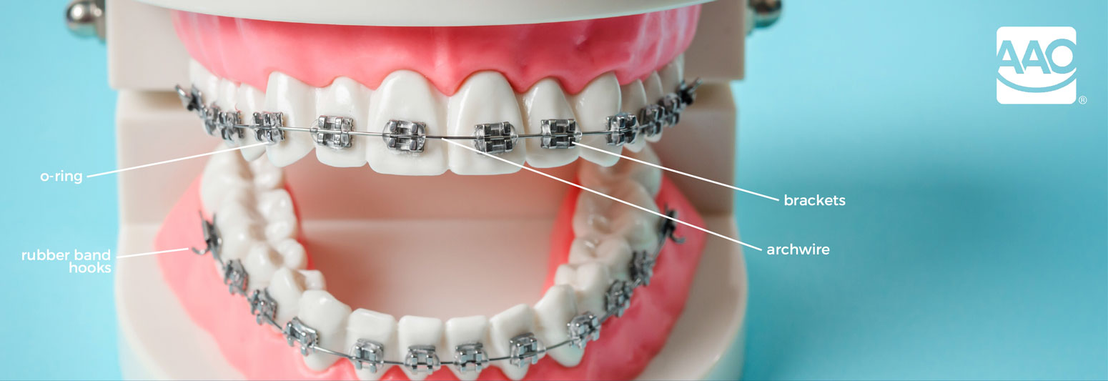 How to Handle Pokey Wires and Home and Other Orthodontic Tips